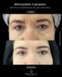 Foto de una blefaroplastia