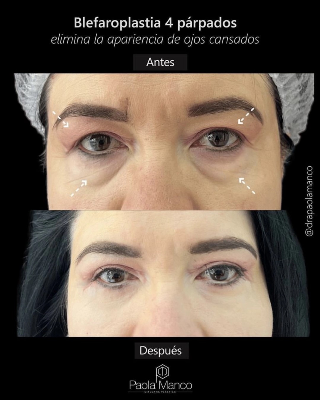 Foto resultados de Blefaroplastia