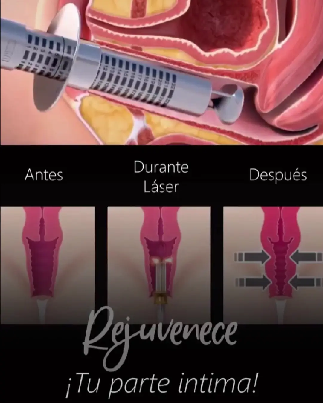 Resultado de Labioplastia