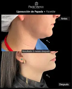 Fotografía de una operación con Paola Manco
