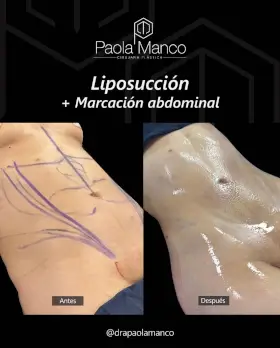 Fotografía de una operación con Paola Manco